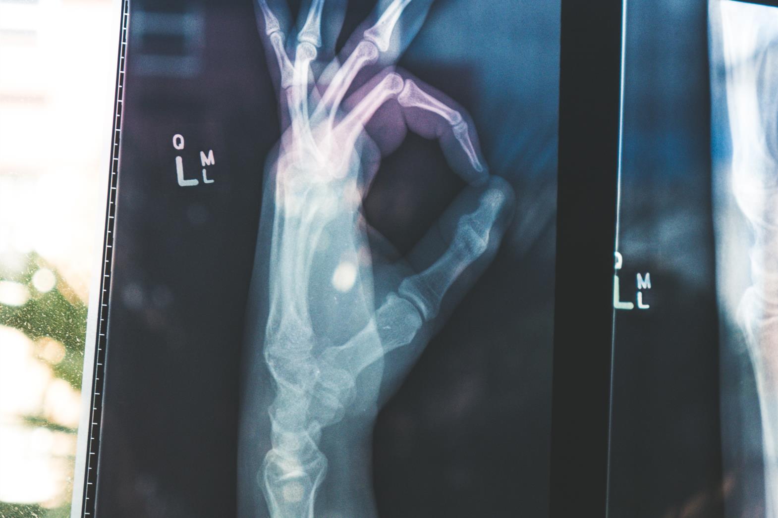 Xray hand photo
